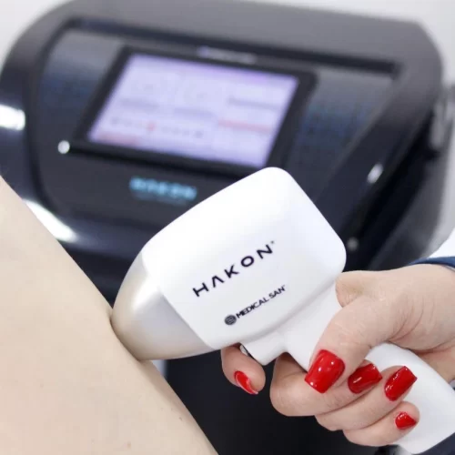 depilacao_laser